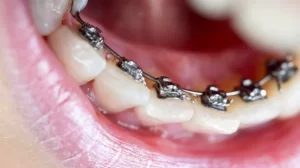 What Kind of Invisalign Is Right for Your Smile?
