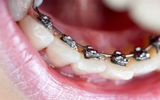 What Kind of Invisalign Is Right for Your Smile?